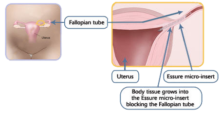 Essure tubal sterilization procedure
